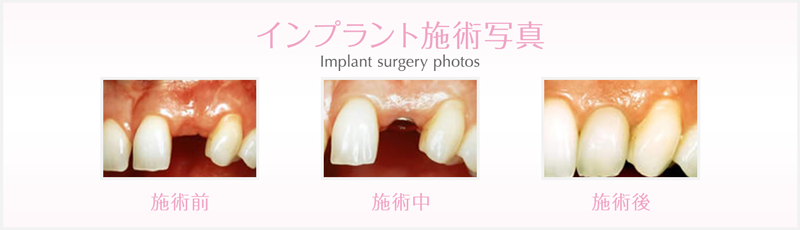 インプラント施術写真