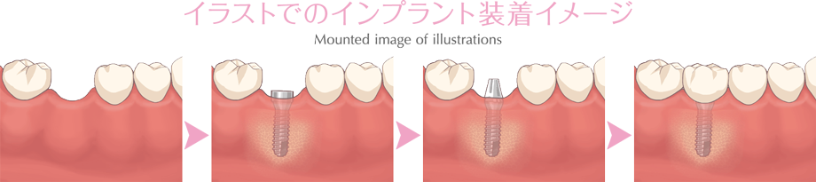 イラストでのインプラント装着イメージ